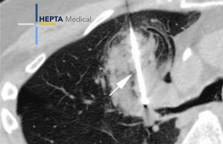 ©HEPTA Medical ©HEPTA Medical